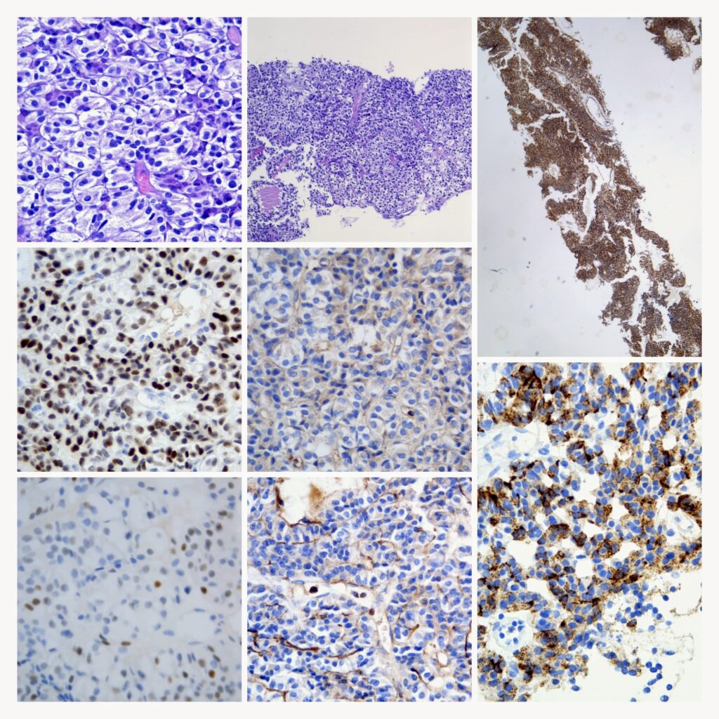 TUMOR NEUROENDOCRINO DE PANCREAS