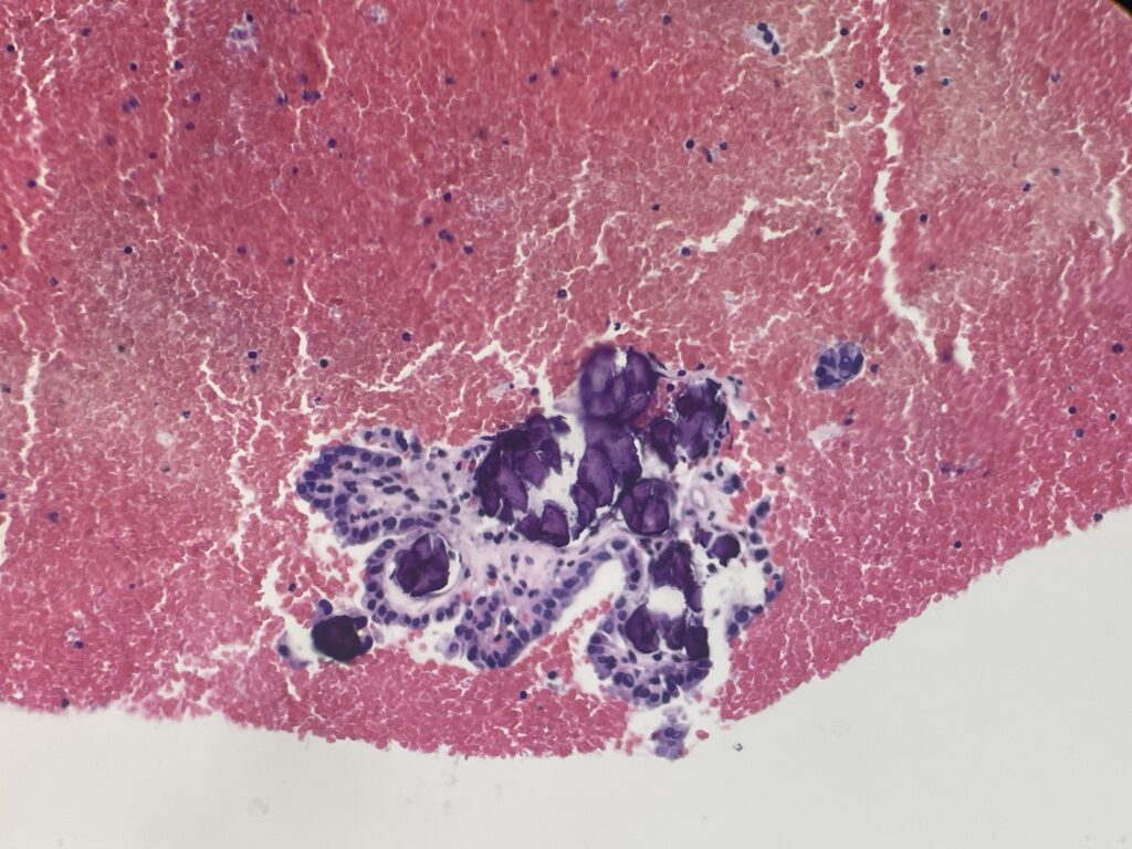 Bethesda de Tiroides Clase V