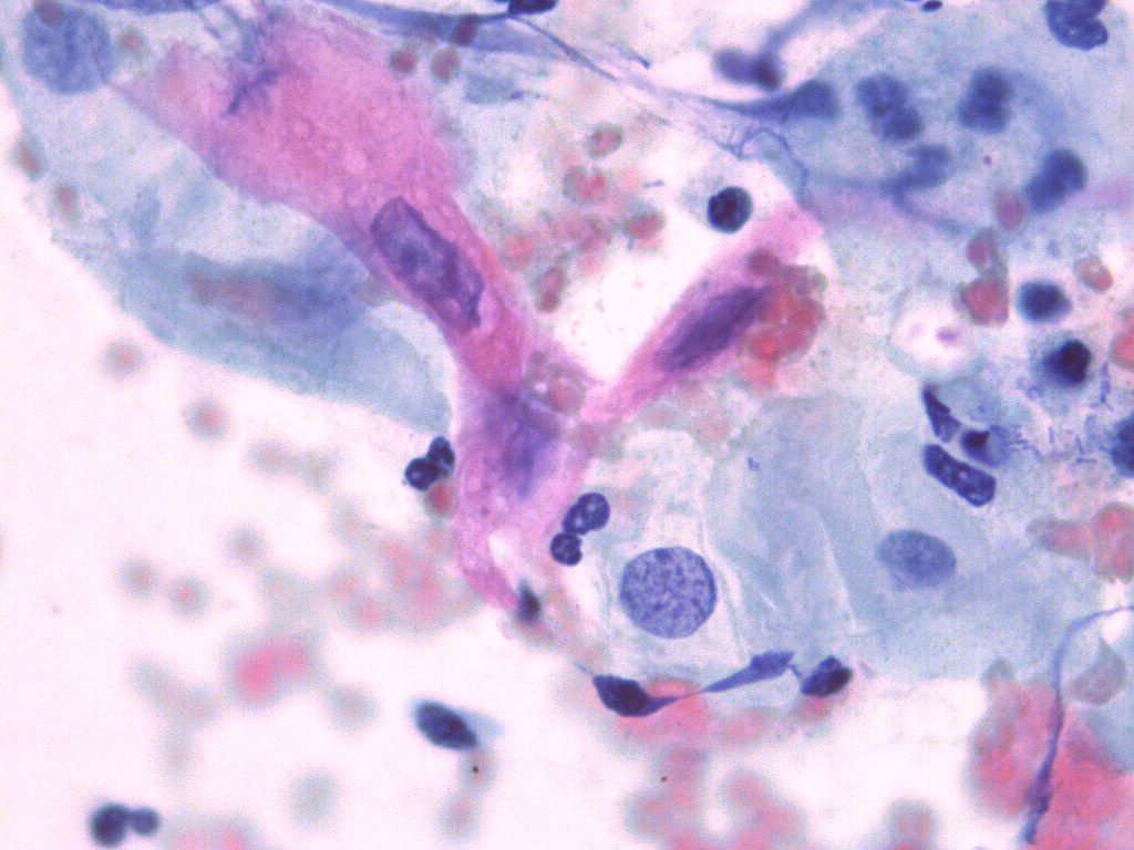 Citología Papanicolau con LIEAG