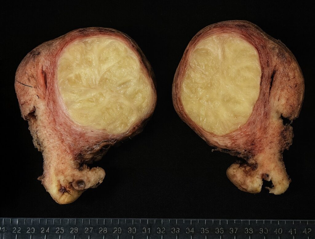 Lipoleiomioma/Leiomioma