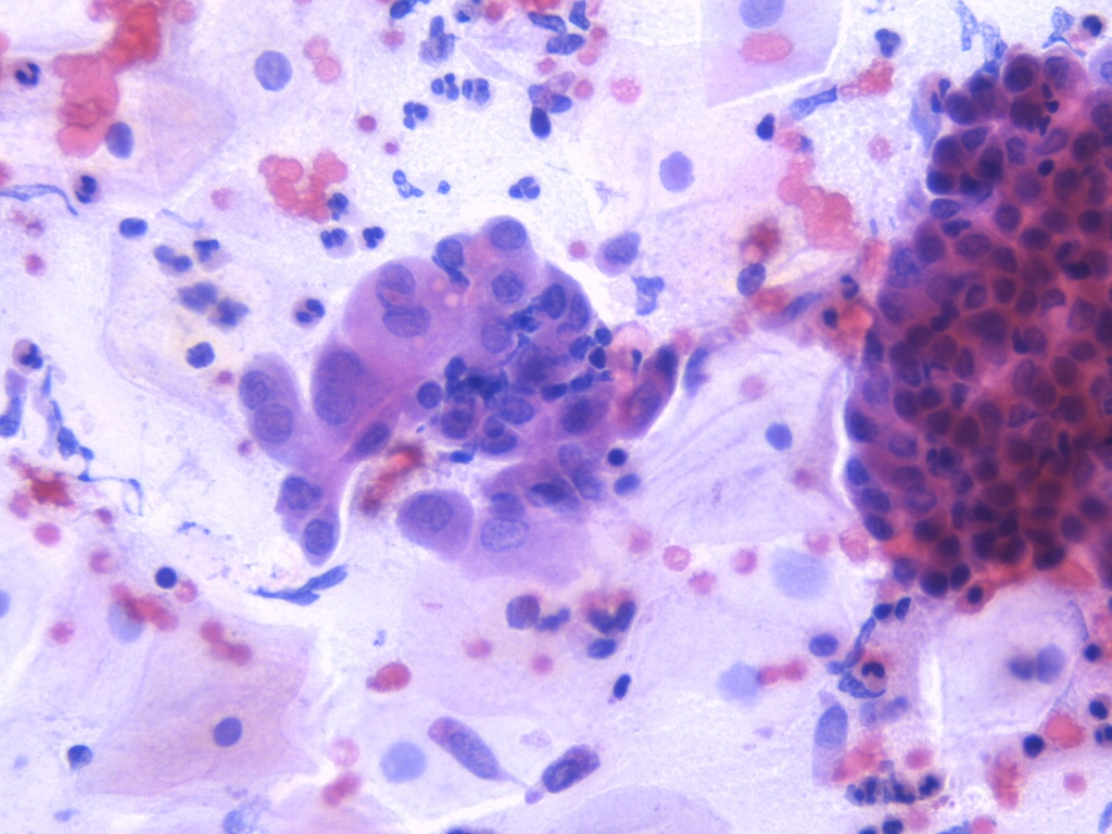 Adenocarcinoma en Líquido peritoneal